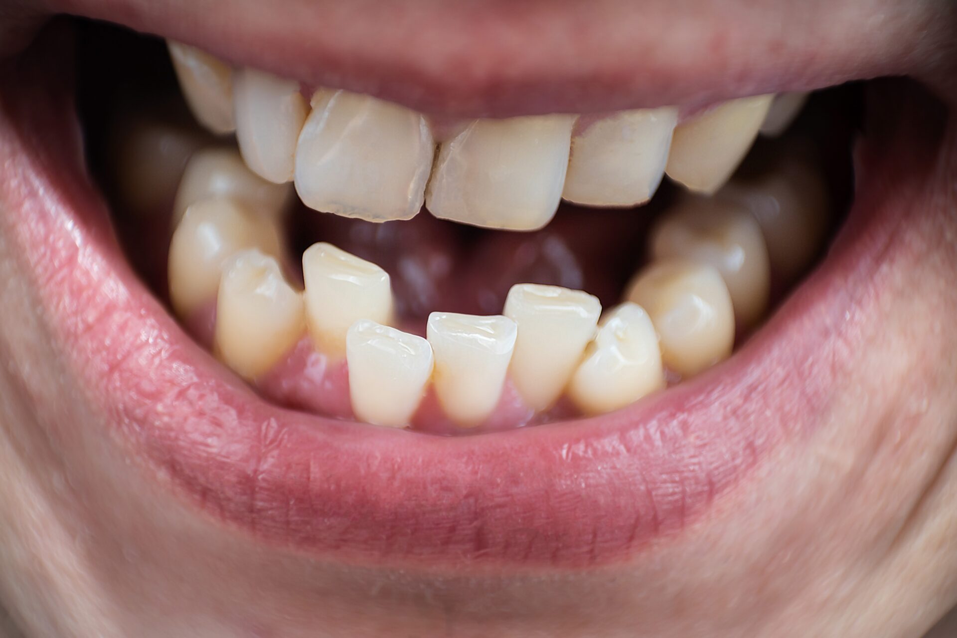 7 Different Kinds of Teeth Misalignment and How to Fix Them