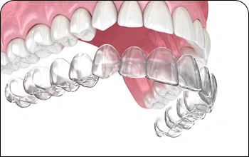 Illustration of clear aligners on upper teeth for discreet orthodontic treatment.
