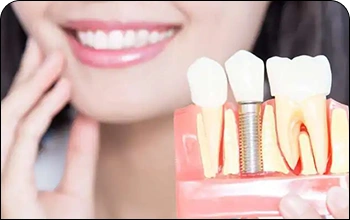 Dental implant model in the foreground with a smiling woman in the background, representing tooth restoration.