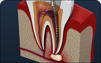Detailed medical illustration of a root canal procedure to treat infected tooth pulp.