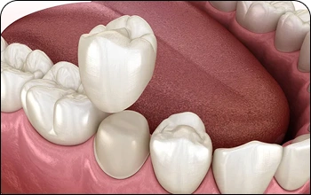 Digital illustration of a tooth replacement procedure showcasing cosmetic dentistry results.