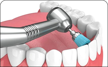 Professional dental cleaning illustration showing plaque removal with specialized tools.