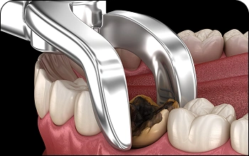 Gentle tooth extraction procedure using modern tools for painless dentistry.