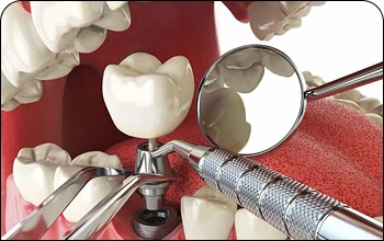 Illustration of teeth replacement