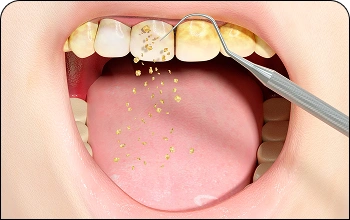 Teeth whitening illustration showing a deep cleaning procedure to remove stains and yellowing.