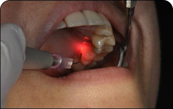 Close-up of a patient receiving advanced laser dentistry treatment for gum health.