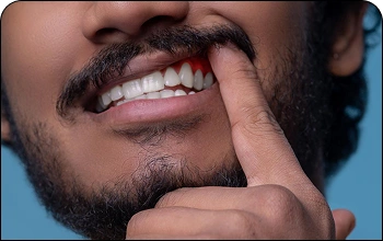 Patient lifting upper lip to show bleeding gums, a common sign of gingivitis.