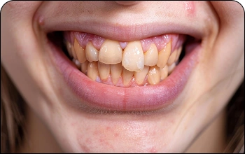 Close-up portrait of a woman with misaligned or crooked teeth before orthodontic treatment.