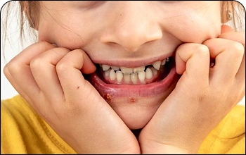 Close-up of a child’s smile showing missing primary teeth or gaps.