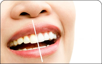 Close-up of teeth showing a side-by-side comparison of professional teeth whitening results.